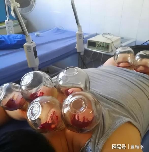 女生美容院拔罐后惊变紫薯精，神秘体验揭秘